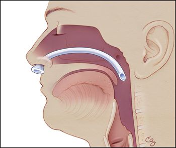 Teleflex Medical назофарингеальная трубка Nasopharyngeal Airway