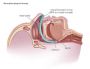 Teleflex Medical назофарингеальная трубка Nasopharyngeal Airway